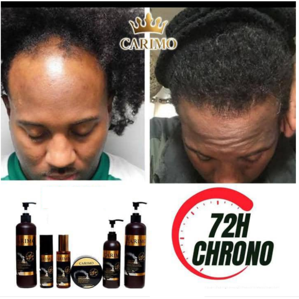 Before and after hair transformation with Carimo Silky hair growth products and '72H Chrono' label.