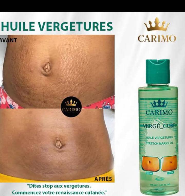 Before and after comparison of stretch marks with Carimo oil bottle on a white background