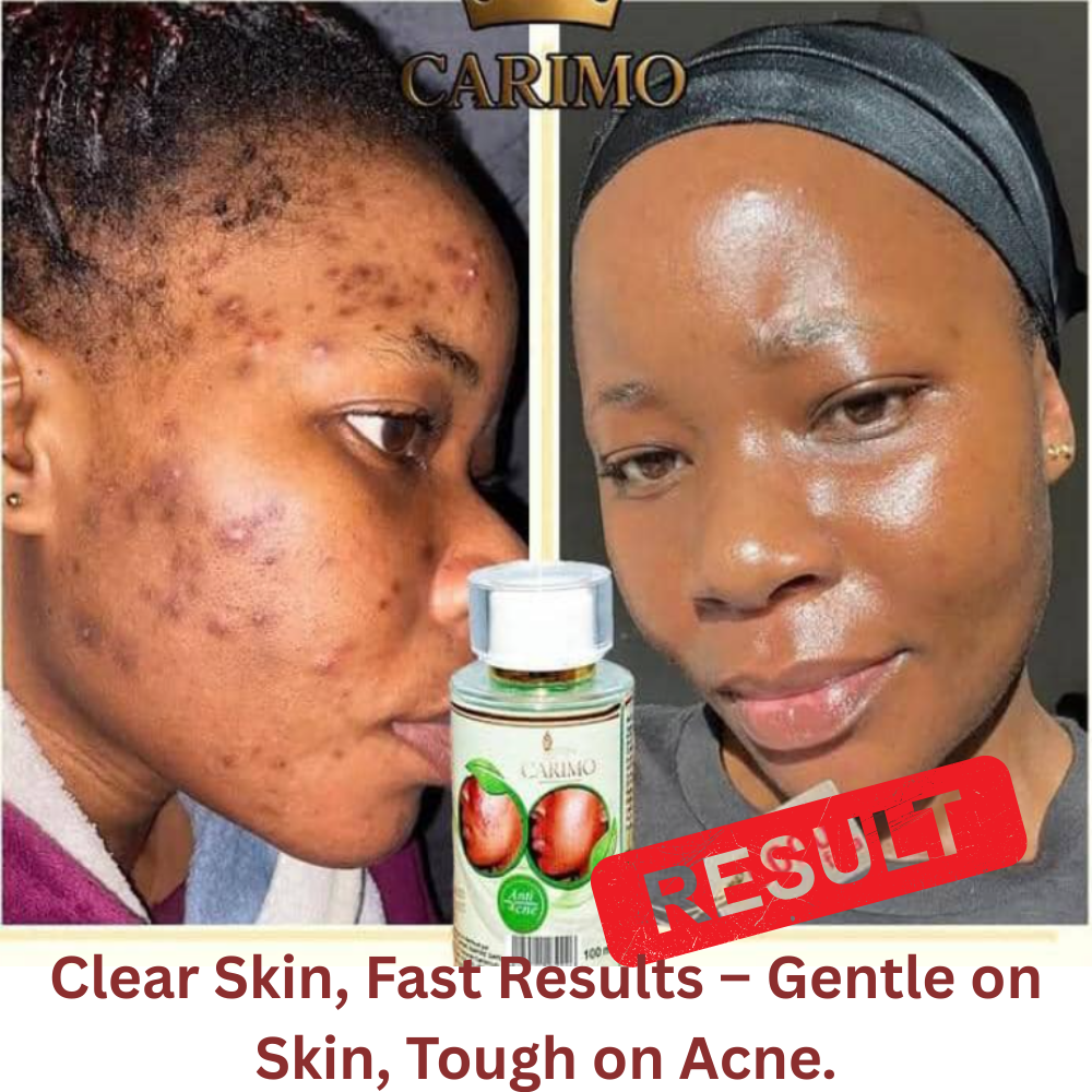 Before and after comparison of a person's face with Carimo  acne lotion product, showing clear skin and text about product benefits.